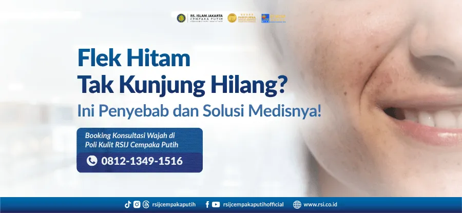 Flek Hitam di Wajah: Penyebab, Jenis, dan Cara Menghilangkannya Secara Medis